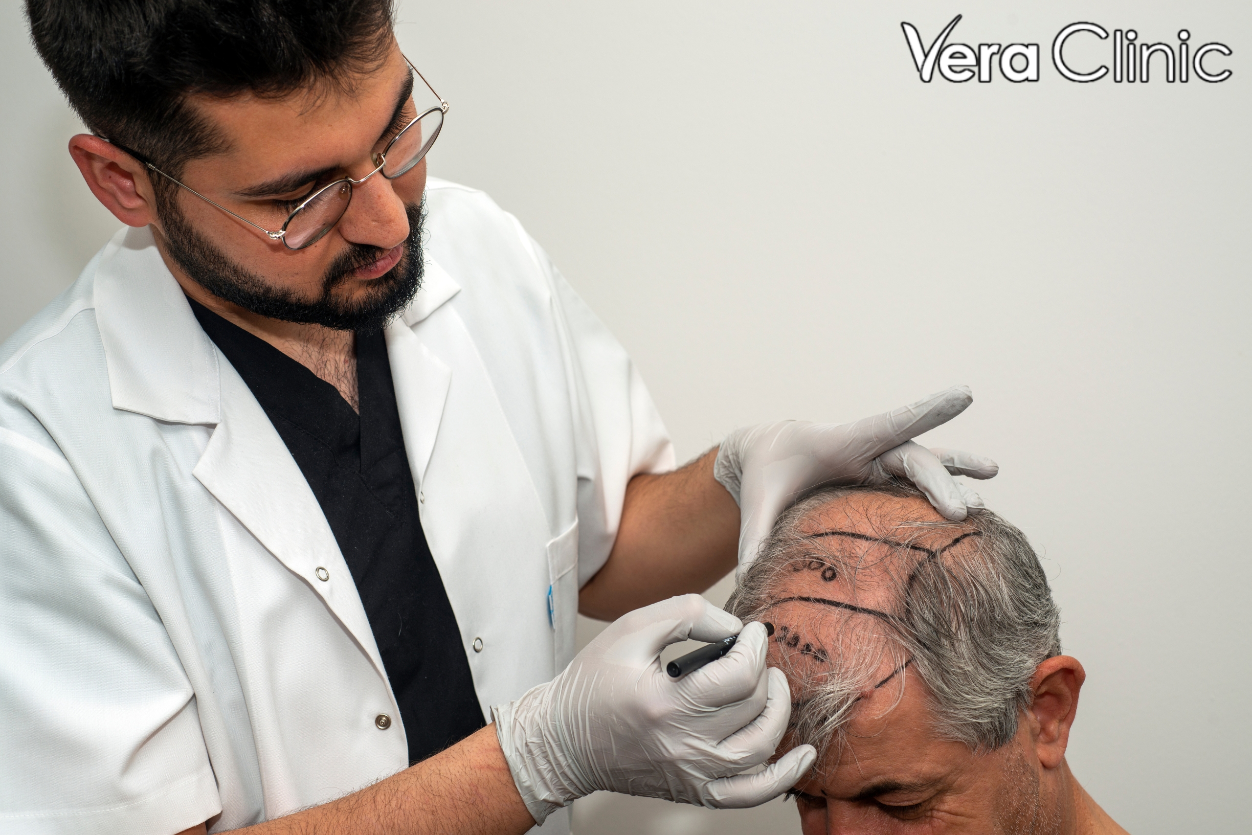 hair implants turkey